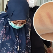 Guru taska didenda selepas kanak-kanak autistik dipukul menggunakan hanger